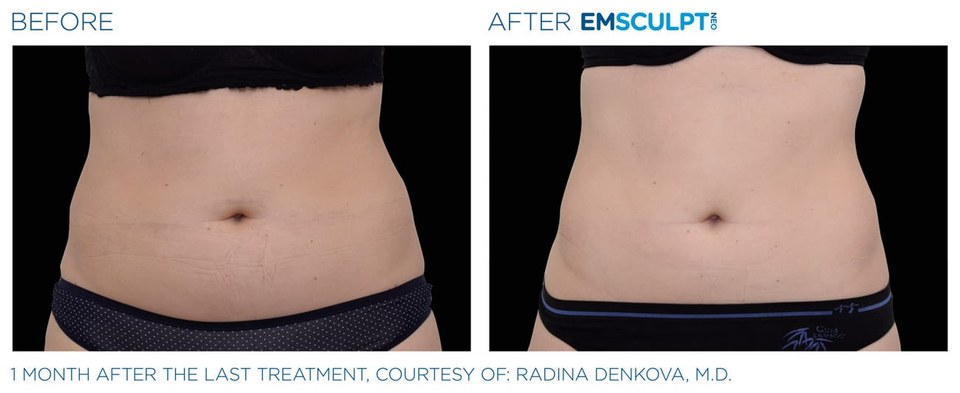 Before and after EMSCULPT NEO: flatter, more toned abdomen one month after a treatment series